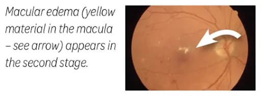 A diagram image showing macular edema in the human eye.