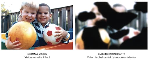 Image depicting a comparison between normal eye vision and an eye with diabetic retinopathy.