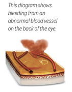 A diagram image showing Vitreous hemorrhage in the back of the human eye.