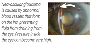 A diagram image showing Neovascular glaucoma in the human eye.
