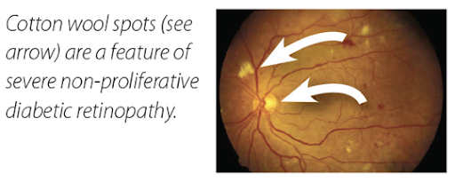 A diagram image showing cotton wool spots in the human eye.