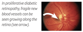 A diagram image showing Proliferative diabetic retinopathy in the human eye.